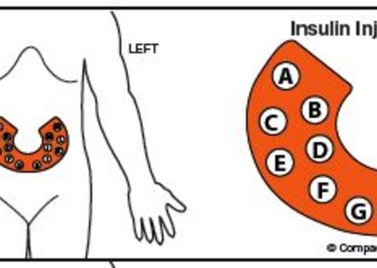 Insulin Injection Rotation Sites Chart